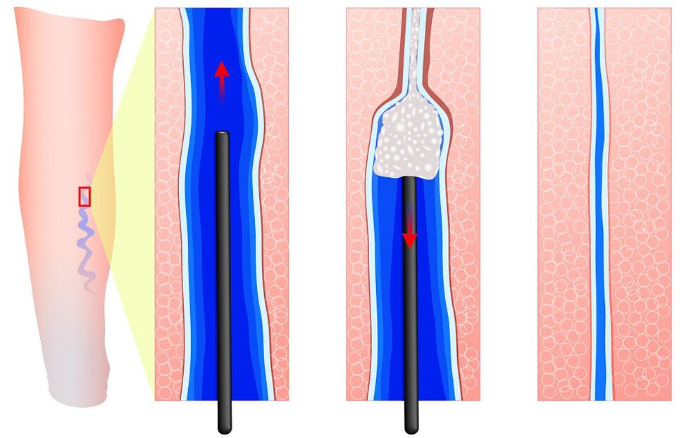 Mechanismus der Sklerotherapie. 